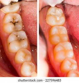 After composite filling